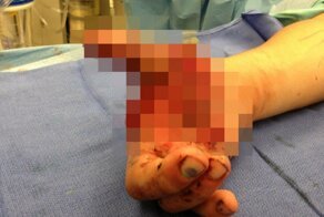 Восстановление руки после взрыва самодельной гранаты