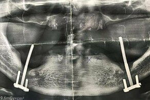 В Бурятии мужчина прожил 27 лет с болтами вместо зубов