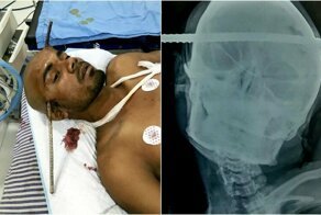 Индийский строитель проткнул голову арматурой и выжил