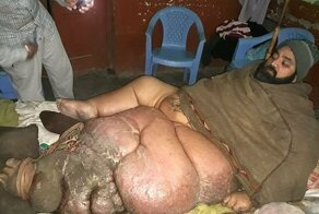 Пакистанец с гигантской ногой согласен на ампутацию
