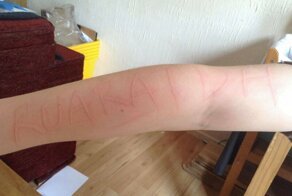 Из-за редкой болезни тело 9-летнего ребенка превратилось в холст для рисования