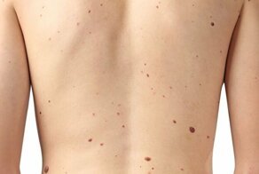 Почему появляются родинки?