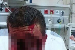 Парень не пристегнулся и лишился лица в ДТП