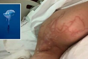 Женщина получила ужасные травмы после того, как её укусила медуза