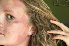 15 человек, которые не умеют пользоваться солнцезащитным средством