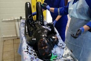 Врачи отчистили и спасли провалившегося в битум жителя Павловска