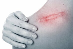 Почему чешется шрам, которому много лет?