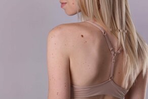 Почему появляется много родинок на теле?