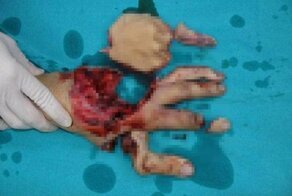 Тайские хирурги проделали грандиозную работу по восстановлению раздробленной руки