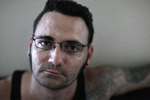 Бывший скинхед уничтожил тату, невзирая на боль