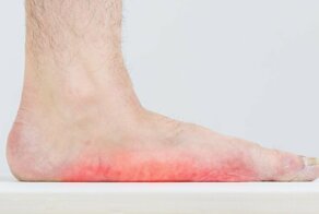 Почему не берут с плоскостопием в армию?