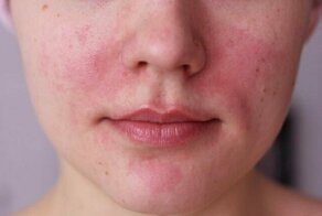 Основные причины, из-за которых краснеет лицо