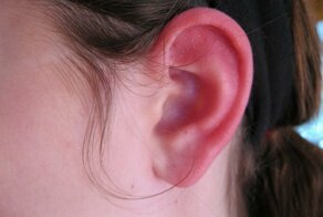 Из-за чего горят уши: медицинское обоснование и народная мудрость