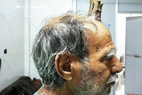 74-летнему индийцу удалили 10-сантиметровый "дьявольский рог"