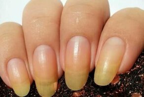 Из-за чего желтеют ногти на руках у женщин, и как можно быстро вернуть красоту