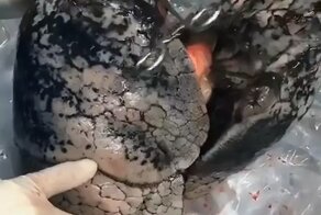Хирурги показали, как выглядят легкие человека после 30 лет курения