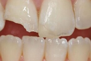 Кариес, генетика, любовь к орешкам и семечкам: почему крошатся зубы?