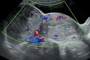 Тело мертвого младенца 15 лет находилось в животе женщины