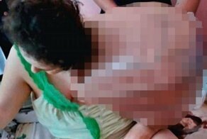 Ужасная массивная опухоль на плече женщины