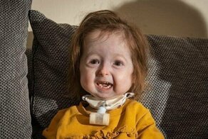 Двухлетняя девочка выглядит как старушка из-за генетической мутации