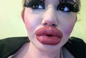 Девушка изменила размер своих губ с помощью 15 хирургических процедур