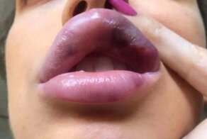 Желая иметь большие губы девушка чуть не лишилась жизни
