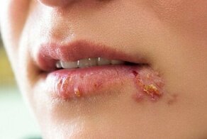 Герпес на губах: причины, терапия и меры профилактики