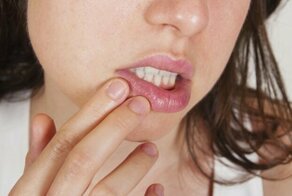 Заеды в уголках рта: причины возникновения, лечение и профилактика