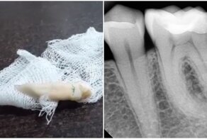 Стоматолог удалил самый большой зуб в мире