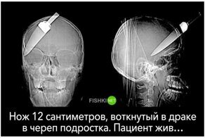 20 случаев из жизни рентгена, который видел некоторый ужас