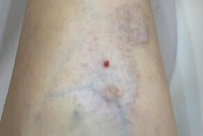 Модель обратилась к косметологу, чтобы избавиться от следа укуса комара, а получила атрофию мышц