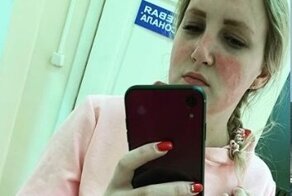Медсестра показала ожоги после ношения костюма химзащиты