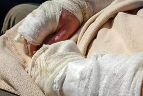 Как сейчас выглядит девочка, которая в 5 лет получила ожоги, несовместимые с жизнью
