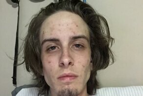 Парень показал фотки до и после лечения от наркомании - лучшая агитация против наркотиков!