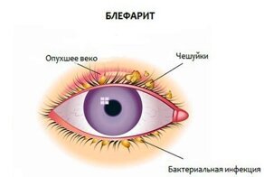 Опух глаз верхнее веко: что делать в домашних условиях