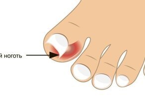 Как лечить вросший ноготь на ноге