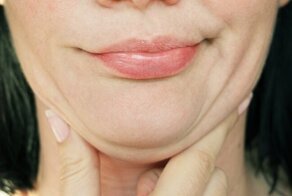 Как убрать второй подбородок