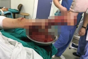 Сельскохозяйственная машина серьезно травмировала ногу юноши