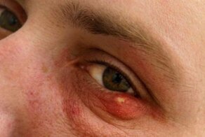 Выбираем эффективное средство от ячменя на глазу: лучшие медикаменты и народные средства