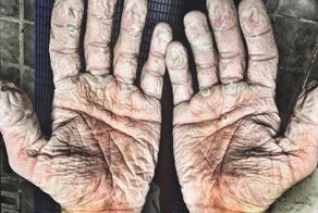 Так выглядят руки после плавания по Северному Ледовитому океану