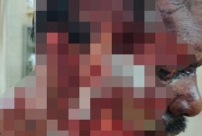 Мотоциклист, попавший в аварию, стесал половину лица об асфальт