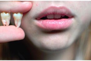 Лишиться зубов из-за операции по снижению веса