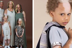 Мальчик с редким заболеванием кожи подписал контракт с модельным агентством