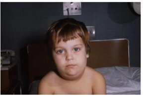 Здравствуйте, свинкой болели?