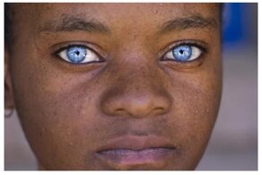 "Красивые глаза" как симптом болезни