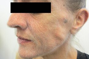 Врачи нашли причину, по которой лицо австралийки обросло шерстью