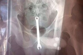 За прошедшие праздники москвич дважды обращался к врачам с деликатной проблемой