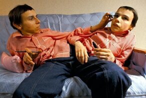 Самые известные сиамские близнецы СССР: жизнь и страдание