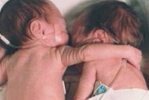 Медсестра кладёт здорового ребёнка рядом с умирающим близнецом и тут происходит настоящее чудо!