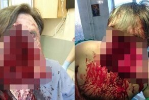 Неудачная попытка самоубийства в Подмосковье: врачи сшили лицо мужчине